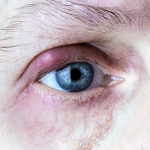 Blepharitis and Stye